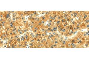 Immunohistochemistry of paraffin-embedded Human liver cancer using THAP3 Polyclonal Antibody at dilution of 1/30 (THAP3 抗体)