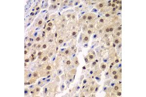 Immunohistochemistry of paraffin-embedded human liver cancer using SF3B2 antibody (ABIN5973482) at dilution of 1/100 (40x lens).