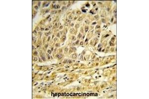 Formalin-fixed and paraffin-embedded human hepatocarcinoma reacted with CCNB1IP1 Antibody (C-term) , which was peroxidase-conjugated to the secondary antibody, followed by DAB staining. (CCNB1IP1 抗体  (C-Term))