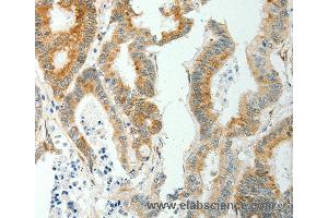 Immunohistochemistry of Human thyroid cancer using SELM Polyclonal Antibody at dilution of 1:50 (SELM 抗体)