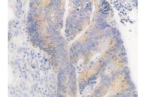 ABIN6260388 and ABIN6279218 at 1/100 staining human colon carcinoma by IHC-P.