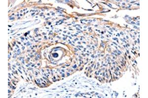The image on the left is immunohistochemistry of paraffin-embedded Human esophagus cancer tissue using ABIN7190097(CCNB2 Antibody) at dilution 1/10, on the right is treated with synthetic peptide. (Cyclin B2 抗体)
