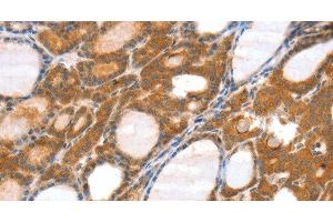 Immunohistochemistry of paraffin-embedded Human thyroid cancer tissue using SRGAP3 Polyclonal Antibody at dilution 1:40