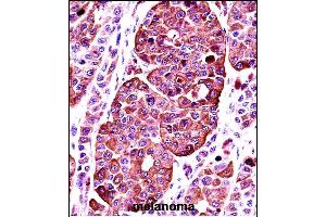 TYR Antibody (Center) ((ABIN391521 and ABIN2841481))immunohistochemistry analysis in formalin fixed and paraffin embedded human melanoma followed by peroxidase conjugation of the secondary antibody and DAB staining. (TYR 抗体  (AA 176-205))