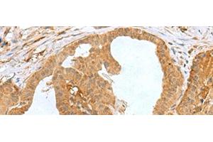 Immunohistochemistry of paraffin-embedded Human thyroid cancer tissue using MRPS28 Polyclonal Antibody at dilution of 1:60(x200) (MRPS28 抗体)