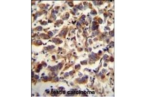 TF antibody (C-term) (ABIN654229 and ABIN2844063) immunohistochemistry analysis in formalin fixed and paraffin embedded human testis carcinoma followed by peroxidase conjugation of the secondary antibody and DAB staining.