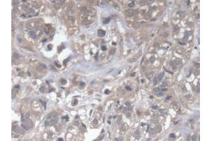 DAB staining on IHC-P; Samples: Human Breast cancer Tissue (DOCK4 抗体  (AA 1-300))