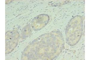 Immunohistochemistry of paraffin-embedded human gastric cancer using ABIN7167836 at dilution of 1:100 (RDH12 抗体  (AA 1-316))