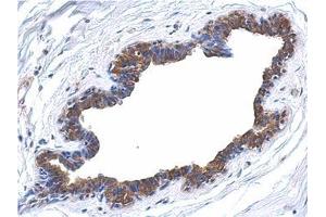 Immunohistochemical analysis of paraffin-embedded breast ca, using AP22398PU-N MAPK4 antibody at 1/500 dilution. (MAPK4 抗体  (N-Term))
