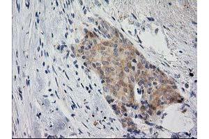 Immunohistochemical staining of paraffin-embedded Adenocarcinoma of Human breast tissue using anti-EIF4E2 mouse monoclonal antibody. (EIF4E2 抗体)