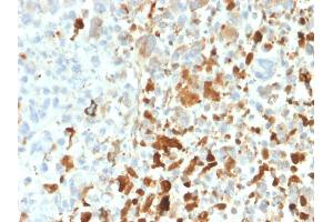 Formalin-fixed, paraffin-embedded human Melanoma stained with Vimentin Rabbit Recombinant Monoclonal Antibody (VIM/1937R). (Recombinant Vimentin 抗体)