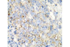 Immunohistochemistry of paraffin-embedded Human esophageal cancer using PRKCQ Polyclonal Antibody at dilution of 1:200 (40x lens). (PKC theta 抗体)
