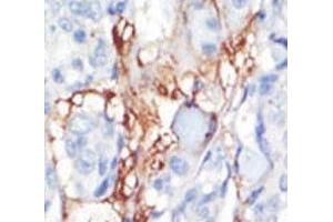 IHC analysis of FFPE human breast carcinoma tissue stained with the PDGFRL antibody (PDGFRL 抗体  (AA 328-357))