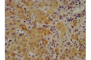 IHC image of ABIN7148361 diluted at 1:700 and staining in paraffin-embedded human liver cancer performed on a Leica BondTM system. (C4A 抗体  (AA 1027-1186))