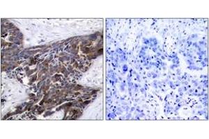Immunohistochemistry analysis of paraffin-embedded human breast carcinoma, using Connexin 43 (Phospho-Ser367) Antibody. (Connexin 43/GJA1 抗体  (pSer367))