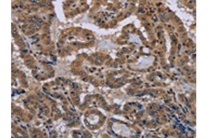 The image on the left is immunohistochemistry of paraffin-embedded Human thyroid cancer tissue using (NPHS2 Antibody) at dilution 1/40, on the right is treated with synthetic peptide. (Podocin 抗体)