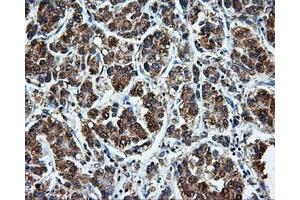 Immunohistochemical staining of paraffin-embedded Carcinoma of liver tissue using anti-LEMD3mouse monoclonal antibody. (LEMD3 抗体)