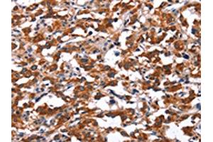The image on the left is immunohistochemistry of paraffin-embedded Human thyroid cancer tissue using ABIN7191188(KCNJ9 Antibody) at dilution 1/15, on the right is treated with synthetic peptide. (KCNJ9 抗体)