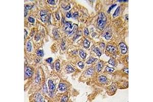 IHC analysis of FFPE human lung carcinoma tissue stained with AKT2 antibody