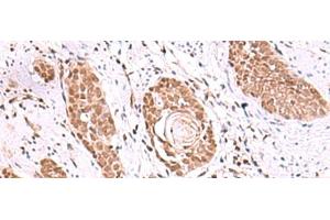 Immunohistochemistry of paraffin-embedded Human esophagus cancer tissue using RUVBL1 Polyclonal Antibody at dilution of 1:85(x200) (RUVBL1 抗体)