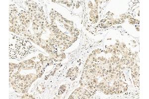 ABIN7094796 and ABIN7098847 at 1/100 staining Human breast cancer by IHC-P. (SF3B1 抗体  (N-Term))