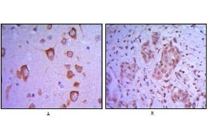 Immunohistochemical analysis of paraffin-embedded human brain tissue (A) and breast tumor (B) uing ETS1 antibody. (ETS1 抗体)