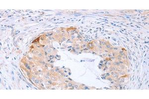 Immunohistochemistry of paraffin-embedded Human cervical cancer tissue using CARD6 Polyclonal Antibody at dilution 1:60 (CARD6 抗体)