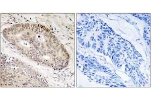 Immunohistochemistry analysis of paraffin-embedded human lung carcinoma tissue, using ALS2CR8 Antibody. (Calcium Responsive Transcription Factor (CARF) (AA 311-360) 抗体)