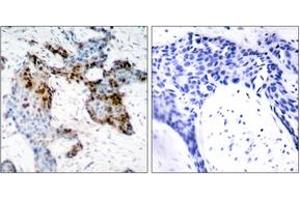 Immunohistochemistry analysis of paraffin-embedded human breast carcinoma tissue, using Estrogen Receptor-alpha (Ab-118) Antibody. (Estrogen Receptor alpha 抗体  (AA 91-140))