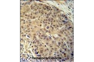 BUD13 antibody (C-term) (ABIN654718 and ABIN2844407) immunohistochemistry analysis in formalin fixed and paraffin embedded human hepatocarcinoma followed by peroxidase conjugation of the secondary antibody and DAB staining. (BUD13 抗体  (C-Term))