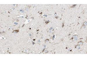 ABIN6275683 at 1/100 staining Human brain cancer tissue by IHC-P. (WASF3 抗体  (Internal Region))