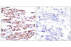 Immunohistochemical analysis of paraffin-embedded human breast carcinoma tissue using JunB(Phospho-Ser79) Antibody(left) or the same antibody preincubated with blocking peptide(right). (JunB 抗体  (pSer79))