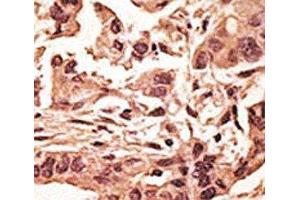 IHC analysis of FFPE human breast carcinoma tissue stained with the SIRT6 antibody (SIRT6 抗体  (AA 290-319))