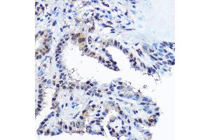 Immunohistochemistry of paraffin-embedded human thyroid cancer using Casein Kinase 2 beta (Casein Kinase 2 beta (CSNK2B)) Rabbit pAb  at dilution of 1:100 (40x lens).