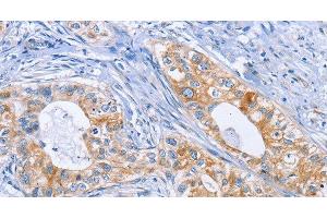 Immunohistochemistry of paraffin-embedded Human cervical cancer tissue using DOK4 Polyclonal Antibody at dilution 1:50 (DOK4 抗体)