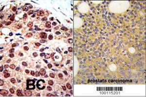 Formalin-fixed and paraffin-embedded human prostata carcinoma tissue reacted with PRMT3 Antibody , which was peroxidase-conjugated to the secondary antibody, followed by DAB staining. (PRMT3 抗体  (C-Term))