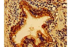 Immunohistochemistry of paraffin-embedded human lung cancer using ABIN7155006 at dilution of 1:100 (HS2ST1 抗体  (AA 29-229))