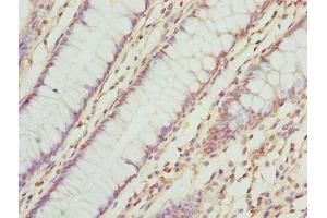 Immunohistochemistry of paraffin-embedded human colon cancer using ABIN7173063 at dilution of 1:100 (TMEM143 抗体  (AA 8-278))