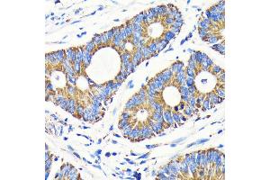 Immunohistochemistry of paraffin-embedded human colon carcinoma using VD antibody (ABIN7271335) at dilution of 1:100 (40x lens). (VDAC1 抗体)