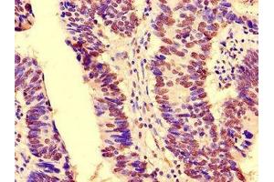 Immunohistochemistry of paraffin-embedded human colon cancer using ABIN7161302 at dilution of 1:100 (NOTCH3 抗体  (AA 1301-1496))