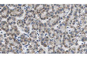 ABIN6268770 at 1/100 staining Human liver cancer tissue by IHC-P. (AQP3 抗体  (Internal Region))