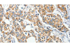 Immunohistochemistry of paraffin-embedded Human breast cancer tissue using IFT74 Polyclonal Antibody at dilution 1:60 (IFT74 抗体)