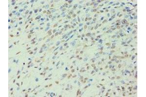 Immunohistochemistry of paraffin-embedded human breast cancer using ABIN7141988 at dilution of 1:100 (BCKDK 抗体  (AA 153-412))