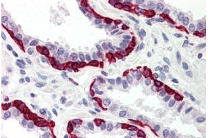 Human Prostate (formalin-fixed, paraffin-embedded) stained with DAPK2 antibody ABIN214481 at 5 ug/ml followed by biotinylated goat anti-rabbit IgG secondary antibody ABIN481713, alkaline phosphatase-streptavidin and chromogen. (DAPK2 抗体  (C-Term))