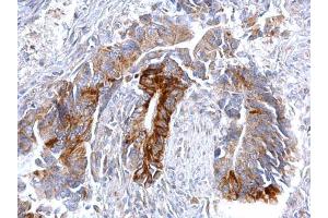 IHC-P Image CCR3 antibody [C2C3], C-term detects CCR3 protein at cytosol on human colon carcinoma by immunohistochemical analysis. (CCR3 抗体  (C-Term))