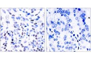 Immunohistochemistry analysis of paraffin-embedded human breast carcinoma tissue, using NF-kappaB p100/p52 (Ab-865) Antibody.