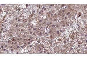 ABIN6277456 at 1/100 staining Human liver cancer tissue by IHC-P. (SCTR 抗体  (Internal Region))