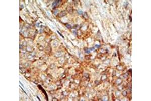 IHC testing of FFPE human breast carcinoma tissue with GCK antibody. (GCK 抗体  (AA 1-30))