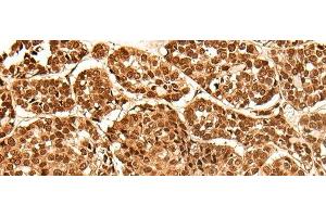 Immunohistochemistry of paraffin-embedded Human esophagus cancer tissue using NEK7 Polyclonal Antibody at dilution of 1:60(x200) (NEK7 抗体)