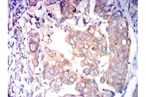 Immunohistochemical analysis of paraffin-embedded breast cancer tissues using FAP mouse mAb with DAB staining. (FAP 抗体  (AA 26-264))